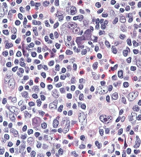 Hodgkin's Lymphoma