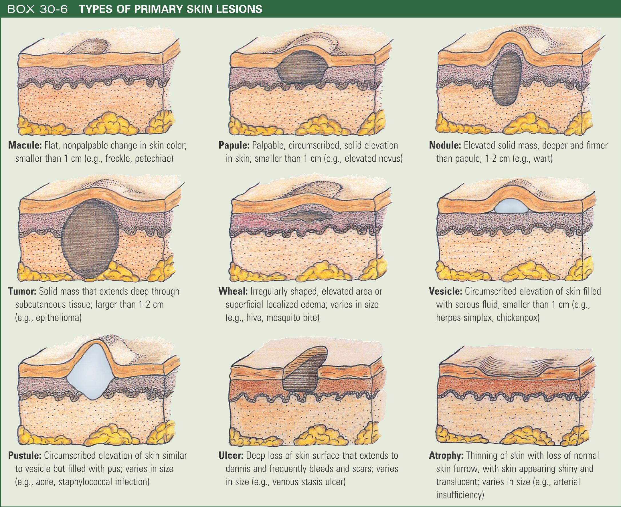 primary skin lesions chart