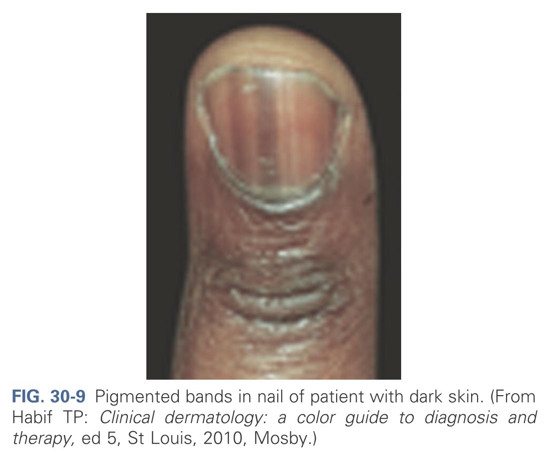 Pigmented bands in nail of patient with dark skin