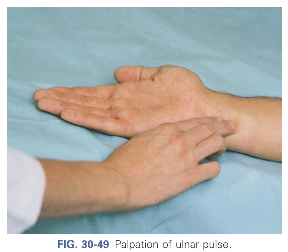 Palpation of ulnar pulse