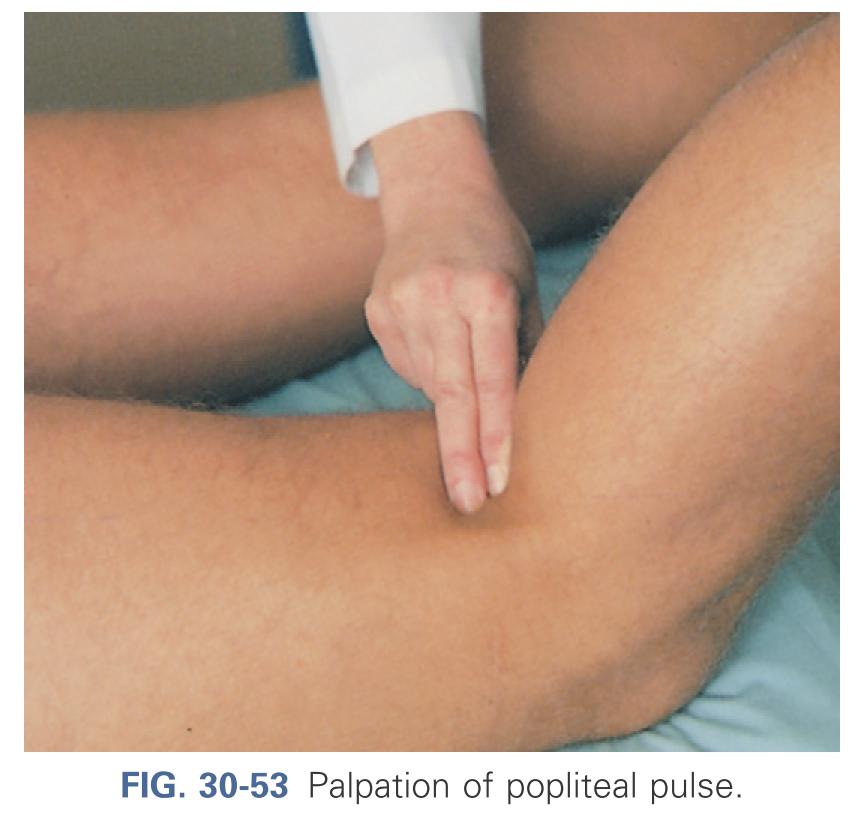 Palpation of popliteal pulse