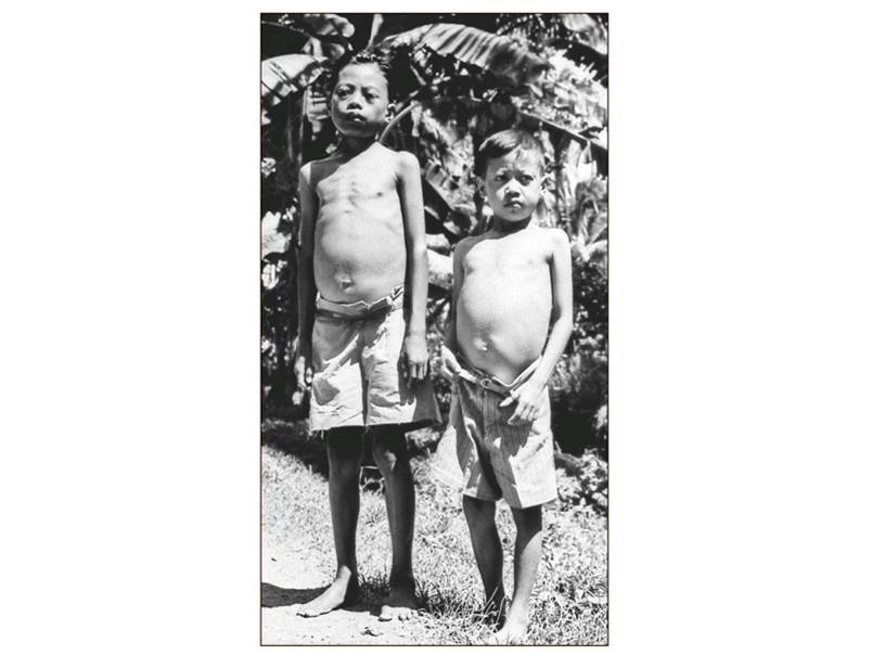 Two children with schistosomiasis.