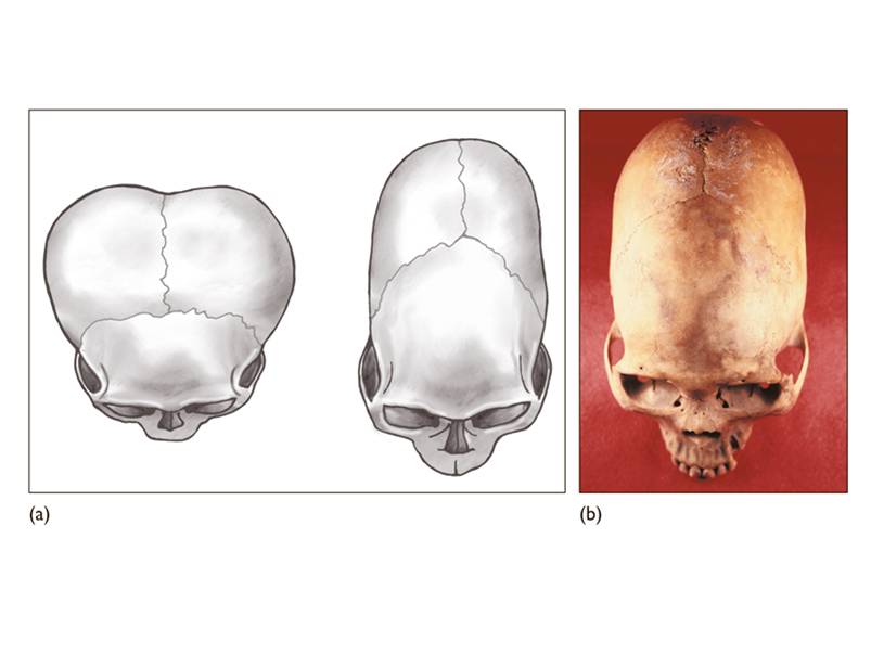 Head binding, or artificial deformation, was used by some populations as a sign of identity. 