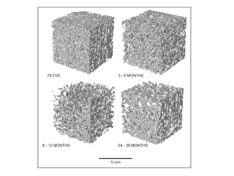 The spongy bone in the top of the femur changes density and organization during growth.