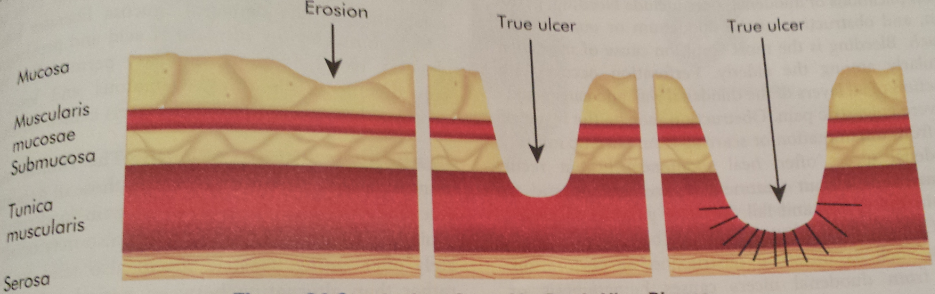 Peptic Ulcer Disease