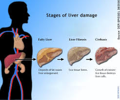 Stages of Liver Damage