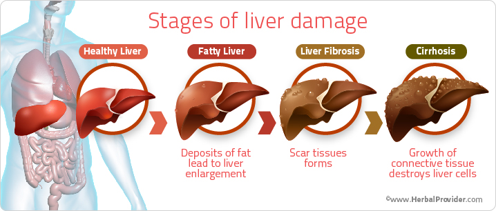 Stages of Liver Damage 2