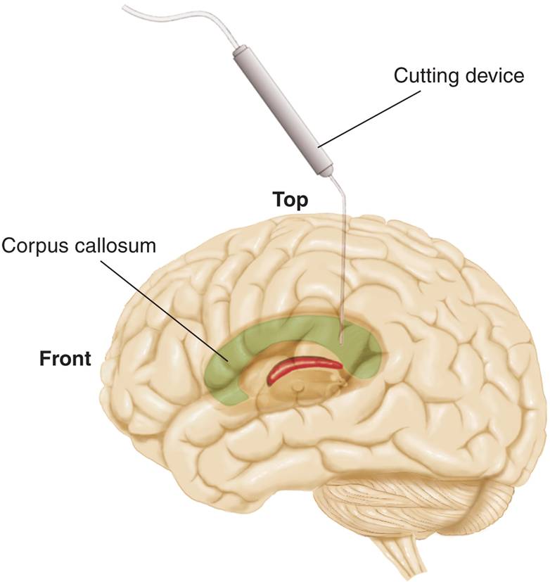 The Split-Brain Operation