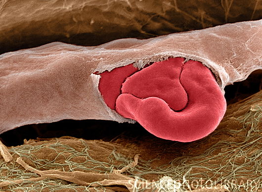 Ruptured capillary