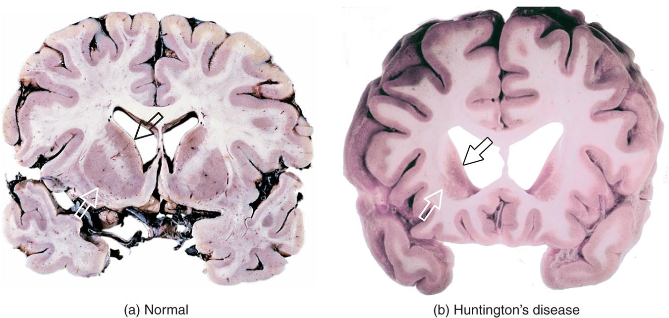 Huntington’s Disease 