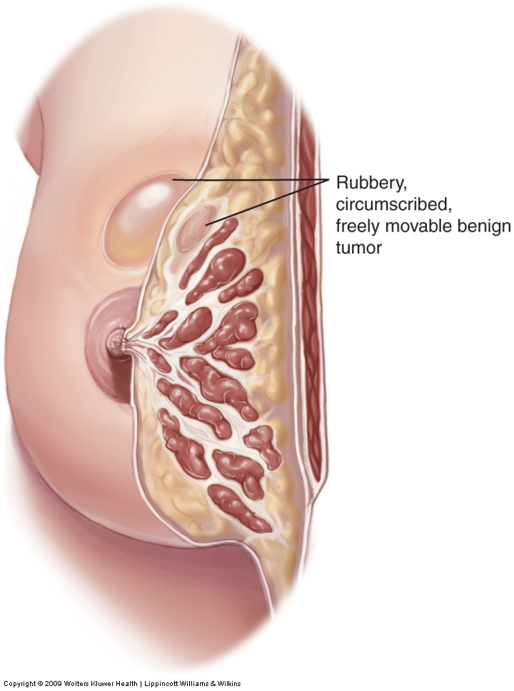 Fibroadenoma. 