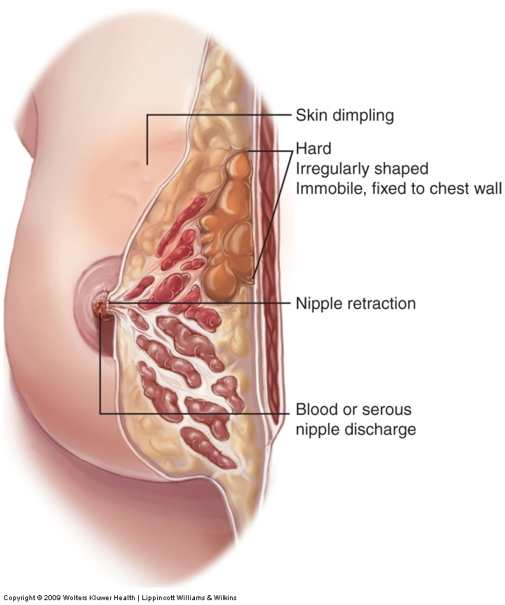 Malignant breast tumor.