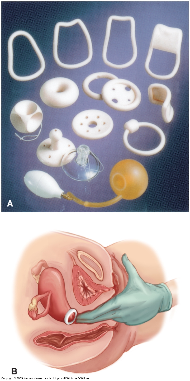 Examples of pessaries. (A) Various shapes and sizes of pessaries available. (B) Insertion of one typ