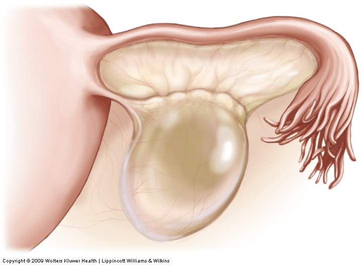 Ovarian cyst.