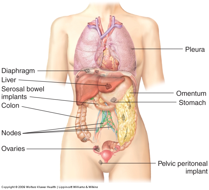 Common metastatic sites for ovarian cancer.