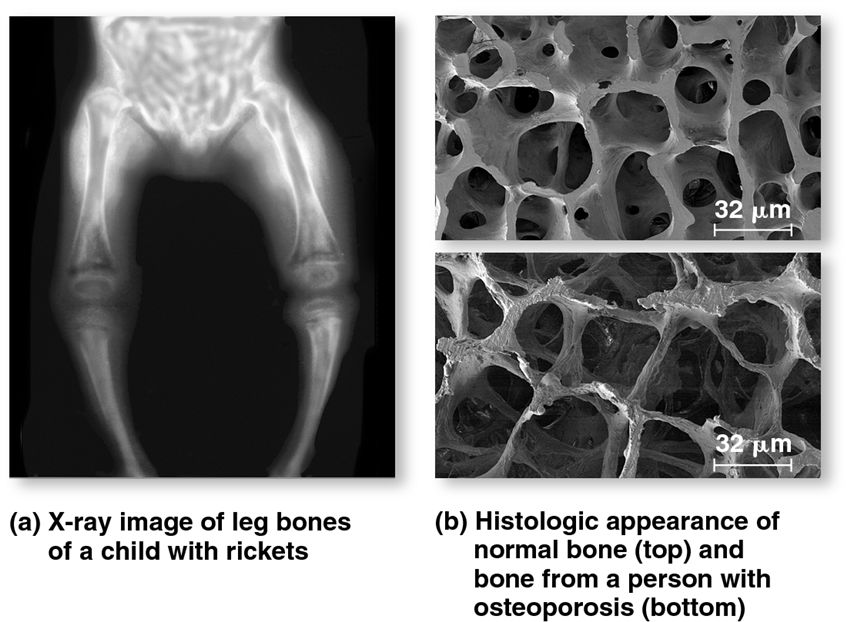 Deformation in human bones caused by (a) rickets and (b) osteoporosis.