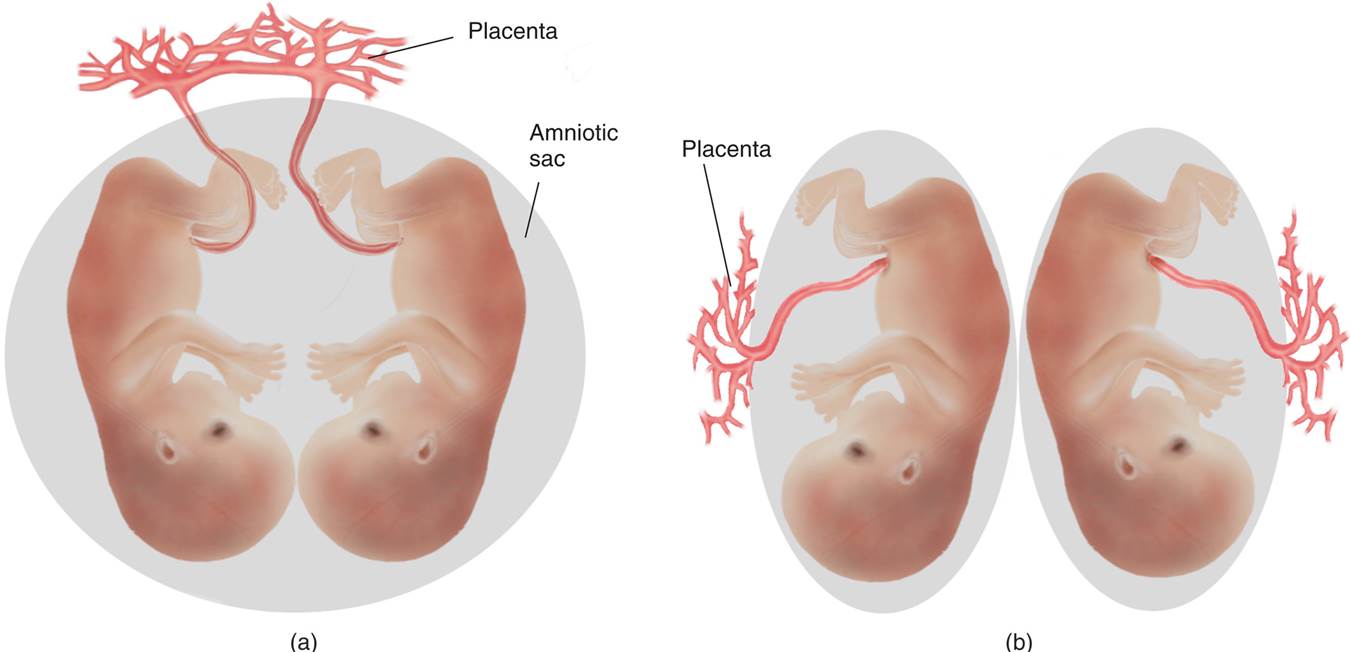 Monozygotic Twins 