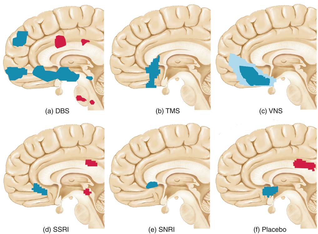 Decreased Activation of the Subgenual ACC After a Variety of Successful Treatments for Depression