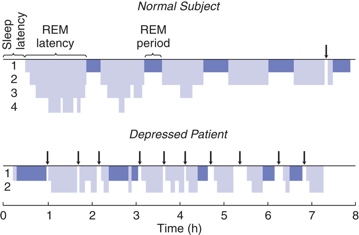 Sleep and Depression 