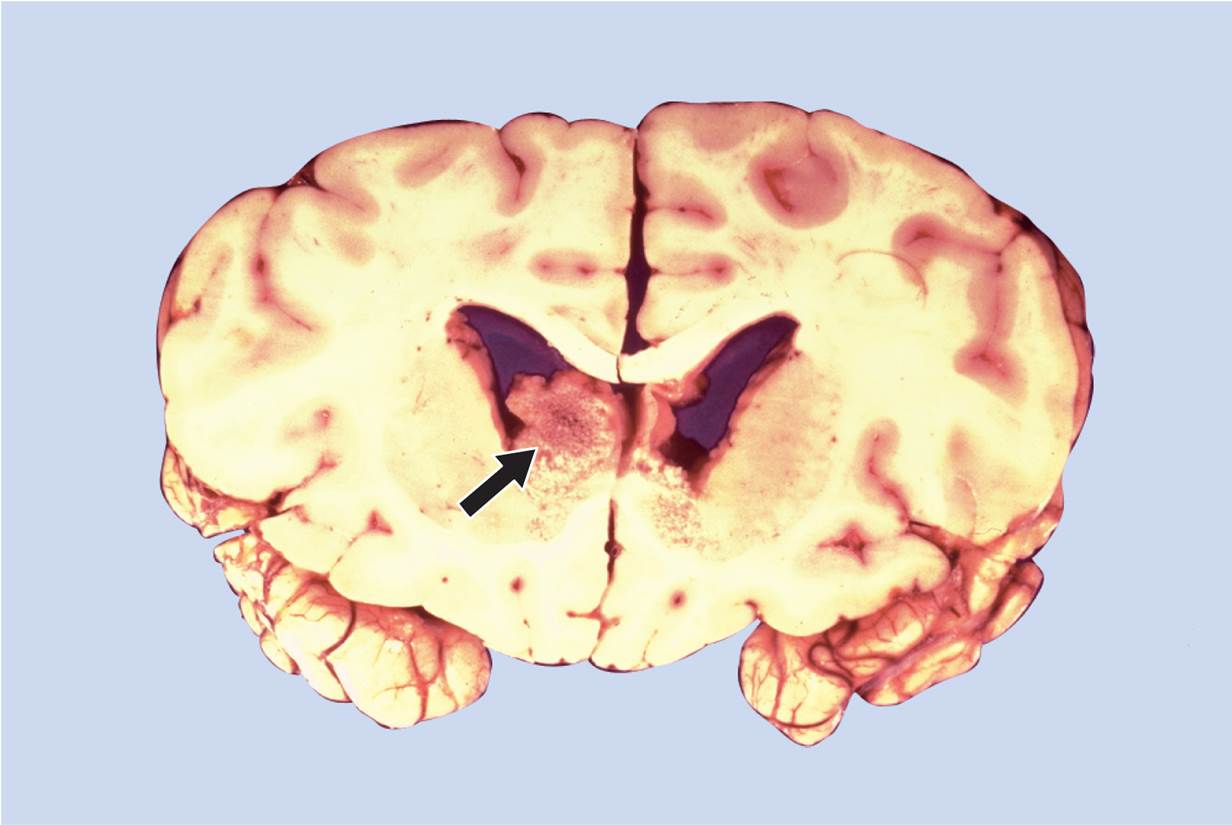 Ependymoma