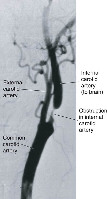 Atherosclerotic Plaque