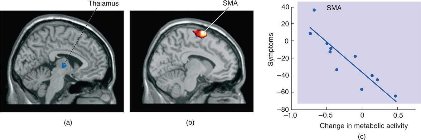 Gene Therapy of Parkinson’s Disease