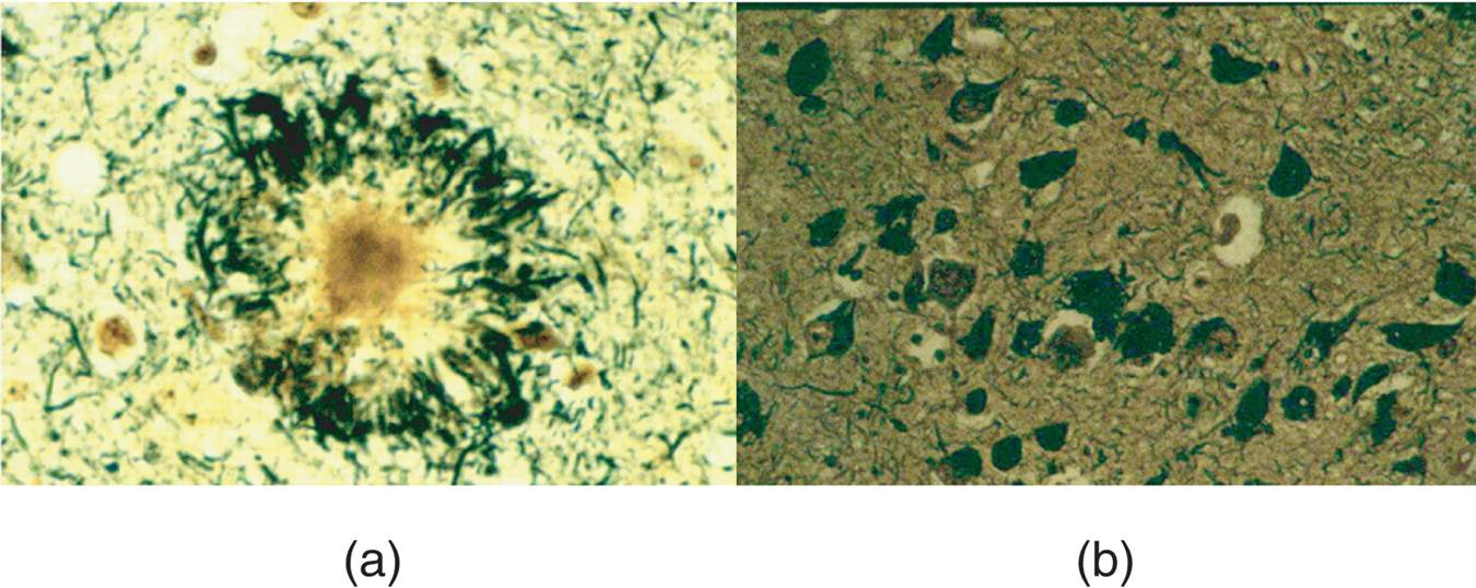 Microscopic Features of Alzheimer’s Disease 