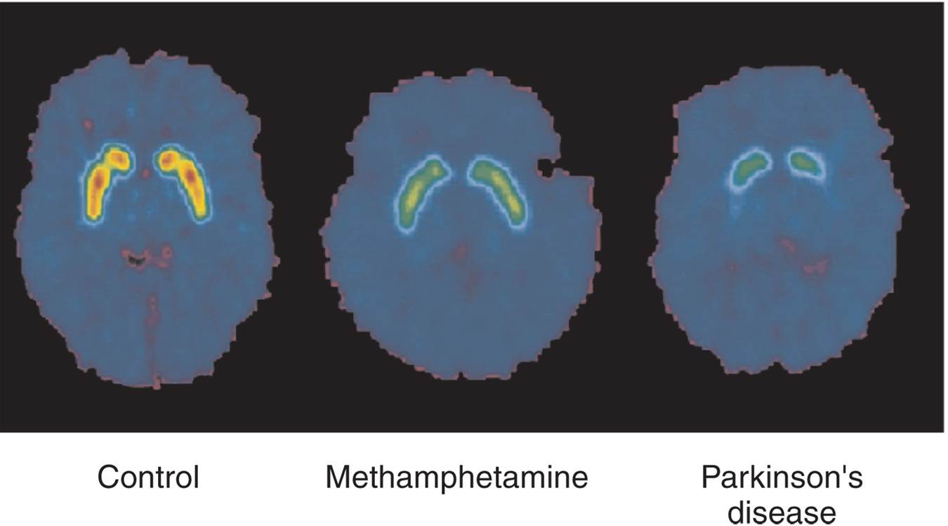 Dopamine Transporters, Methamphetamine Abuse, and Parkinson’s Disease 