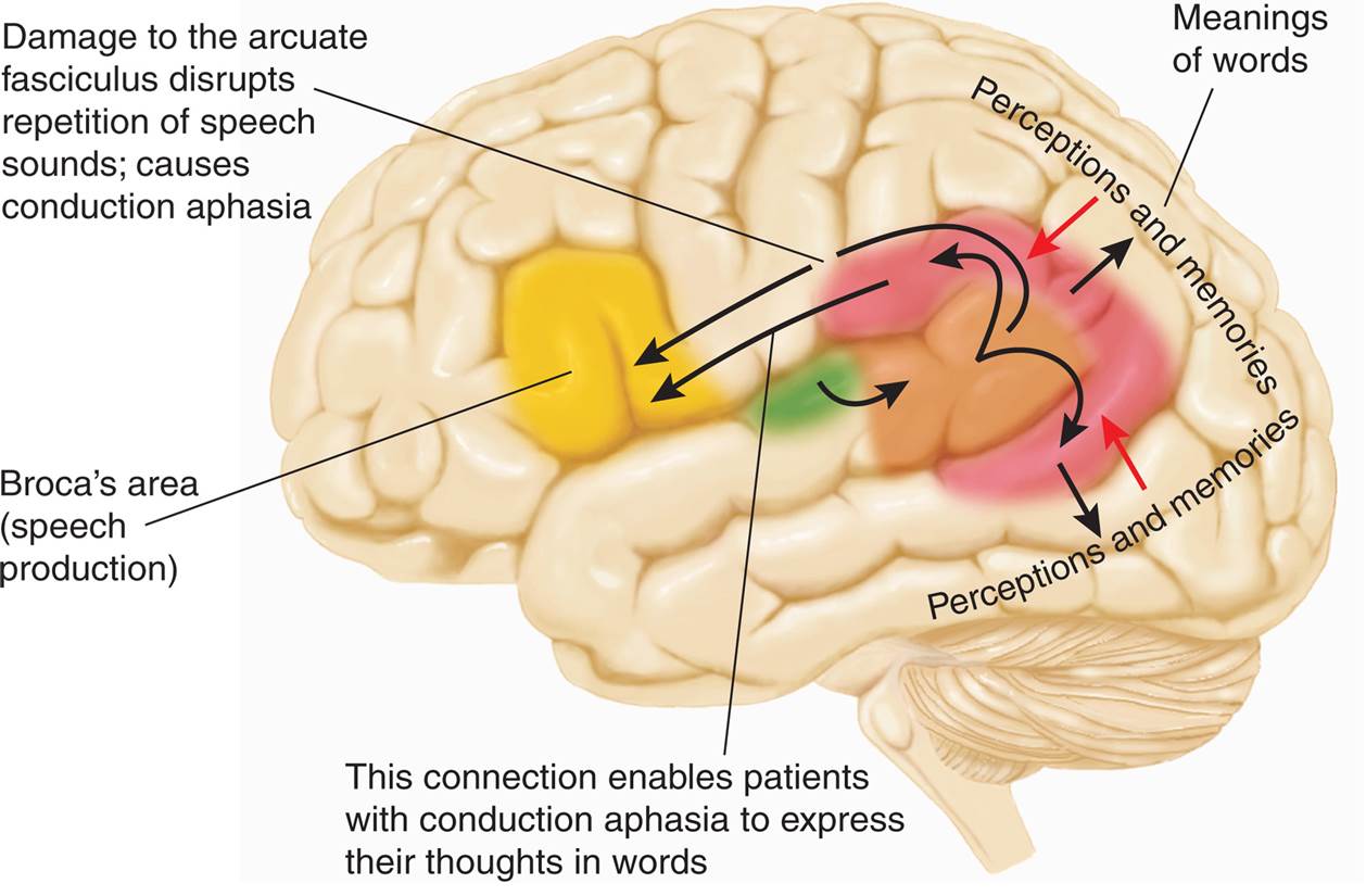 A Hypothetical Explanation of Conduction Aphasia 