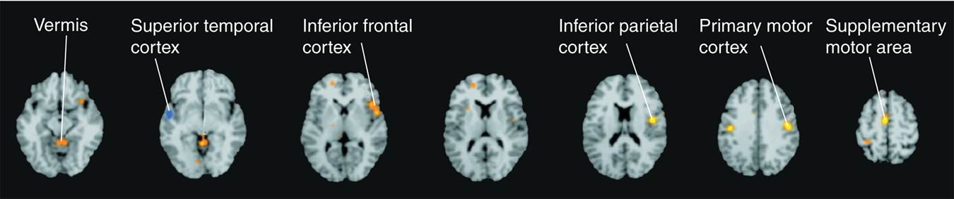 Stuttering and the Brain 