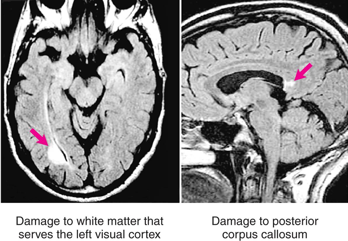 Pure Alexia in a Patient with Multiple Sclerosis 