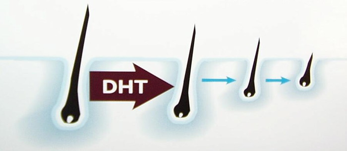 Hair loss due to DHT