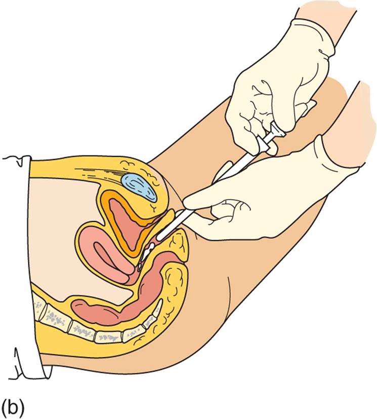 Vaginal drug administration: (b) using an applicator to instill a vaginal cream