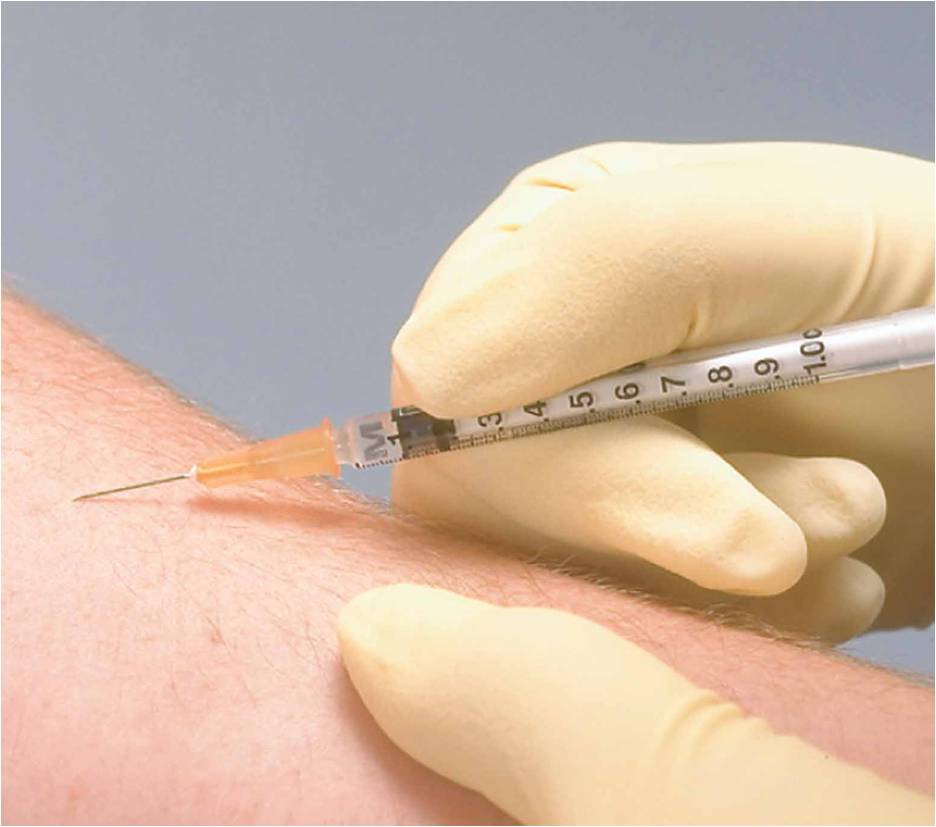 )   Intradermal drug administration: (c) the needle is inserted, bevel up at 10–15° 