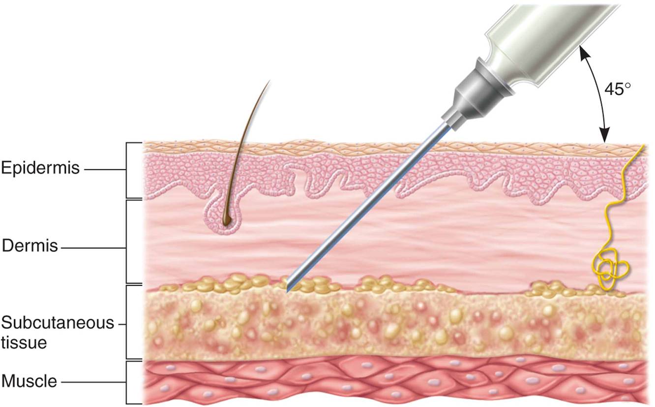 Subcutaneous drug administration: (a) cross section of skin showing depth of needle insertion;