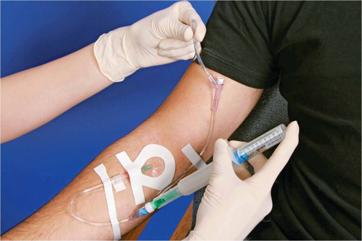 )   IV bolus administration. (b) the drug is administered through the port using a needleless syring