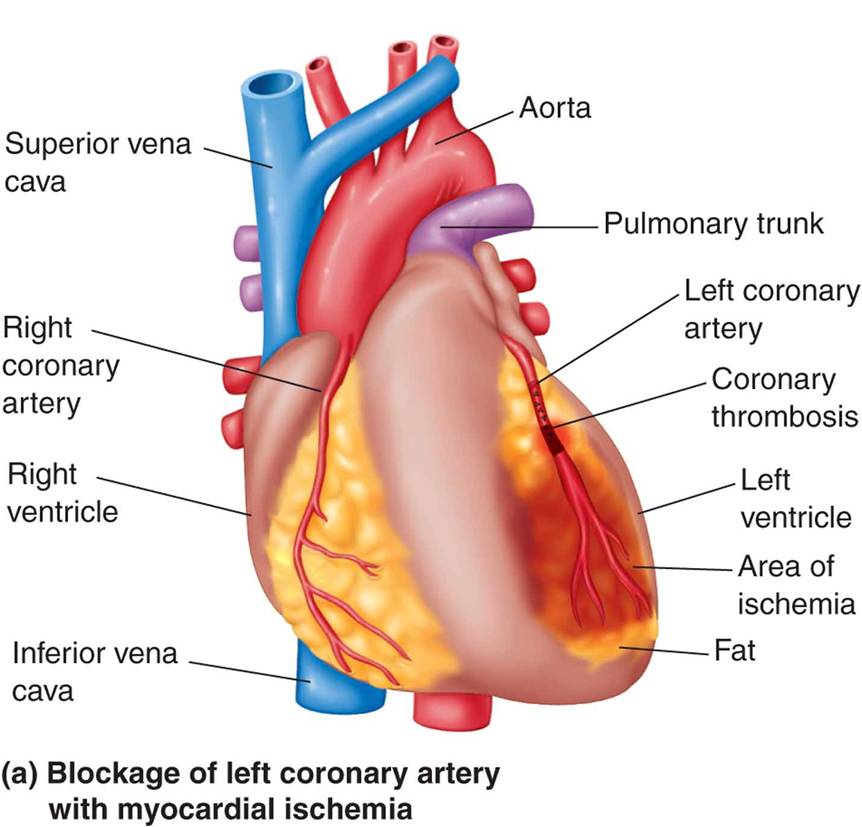 Blockage and reperfusion following myocardial infarction