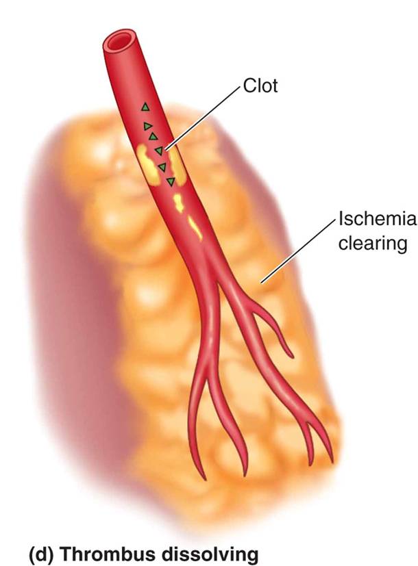 Blockage and reperfusion following myocardial infarction: