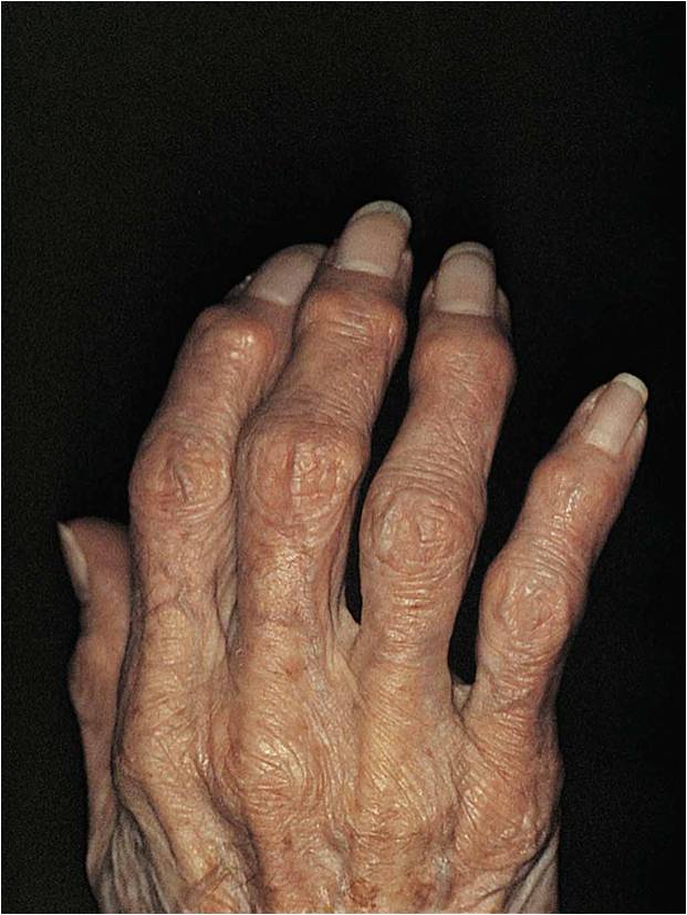 Patient with osteoarthritis