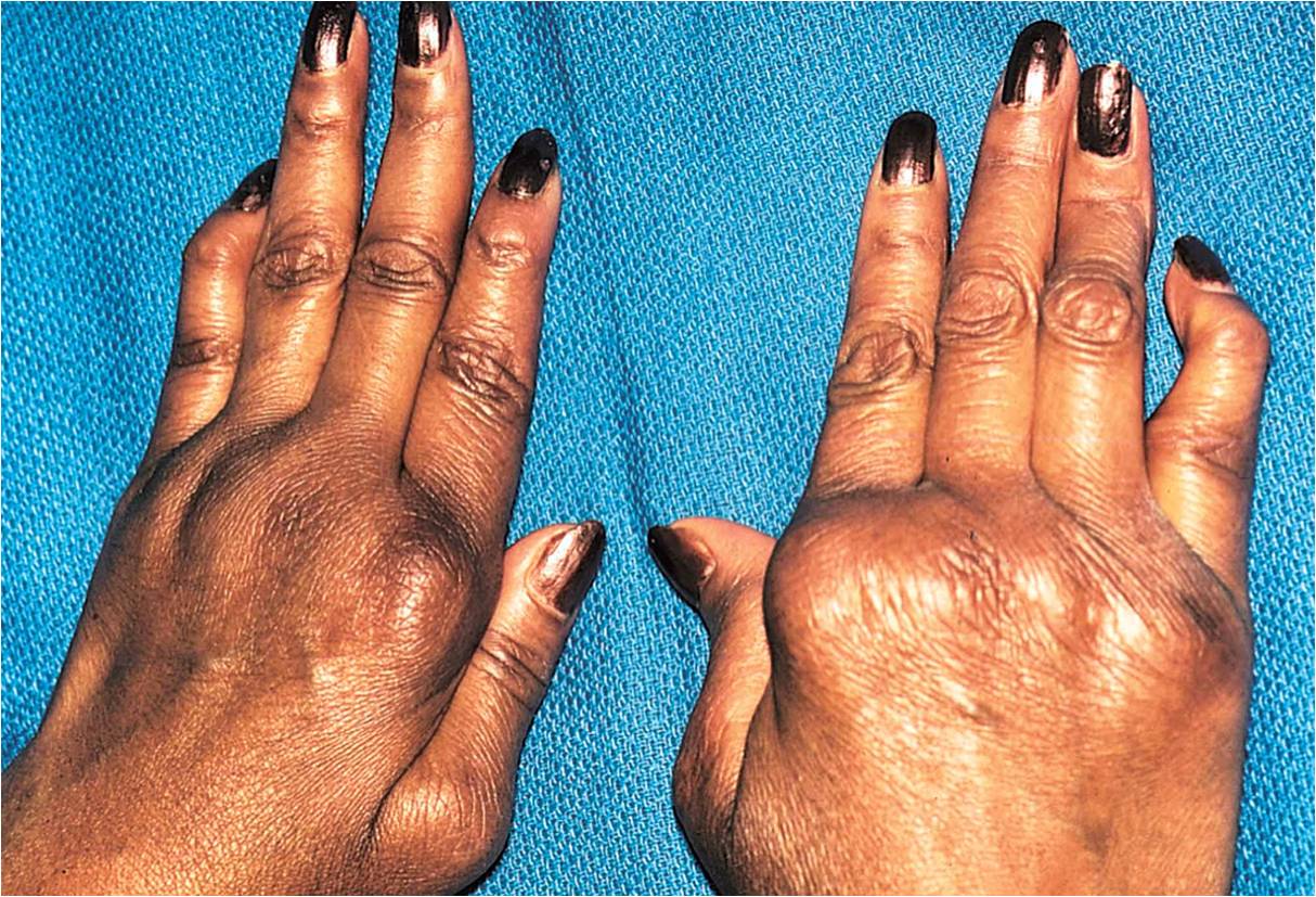 Patient with rheumatoid arthritis