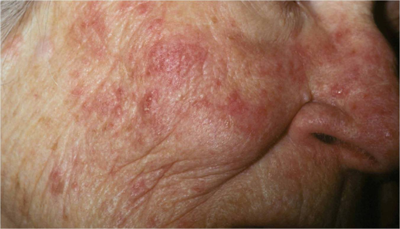 Rosacea