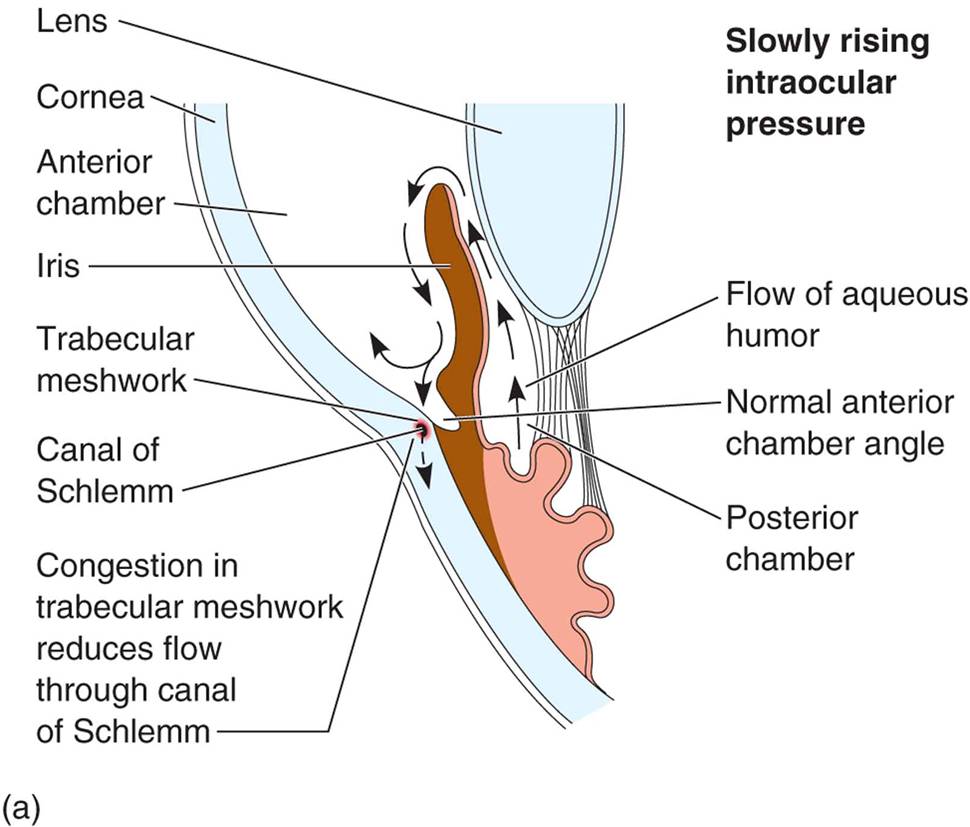 Forms of primary adult glaucoma: (a) in chronic open-angle glaucoma, the anterior chamber angle rema