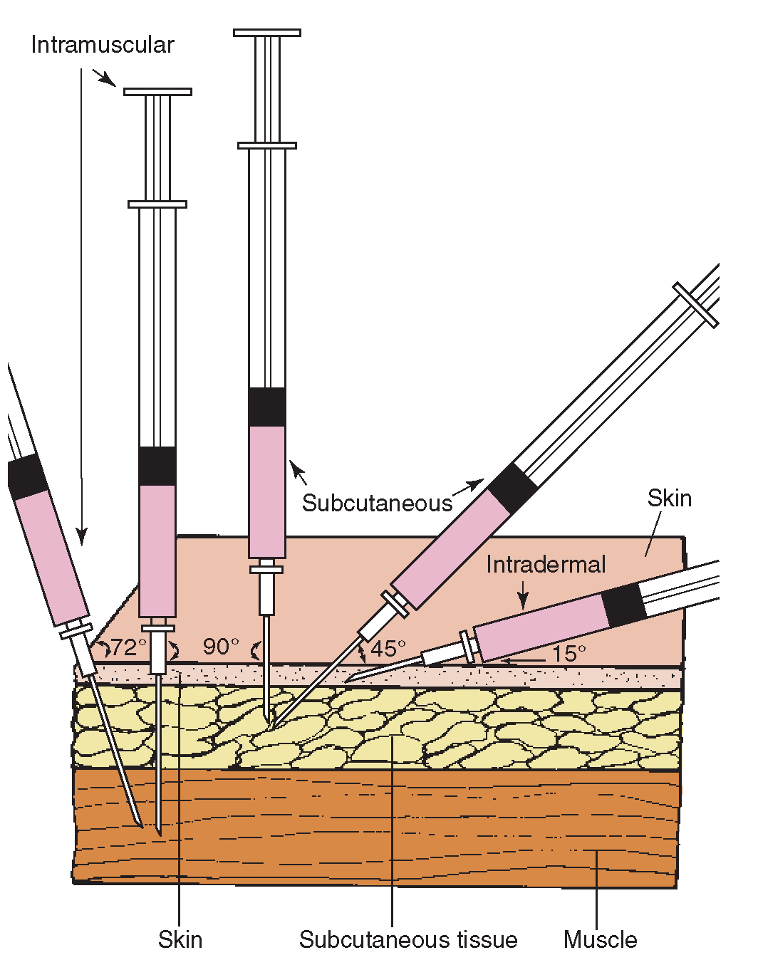 Various Injection angles for insertion