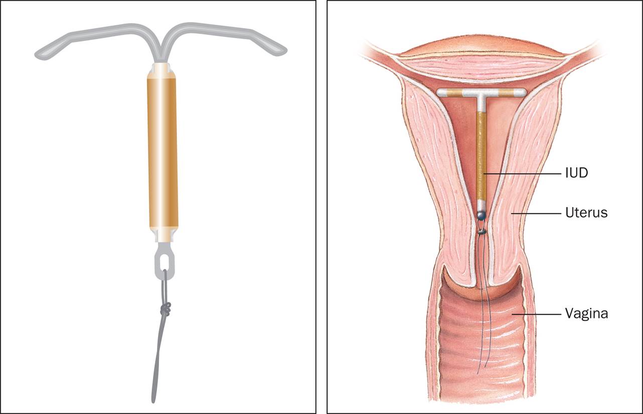 The IUD