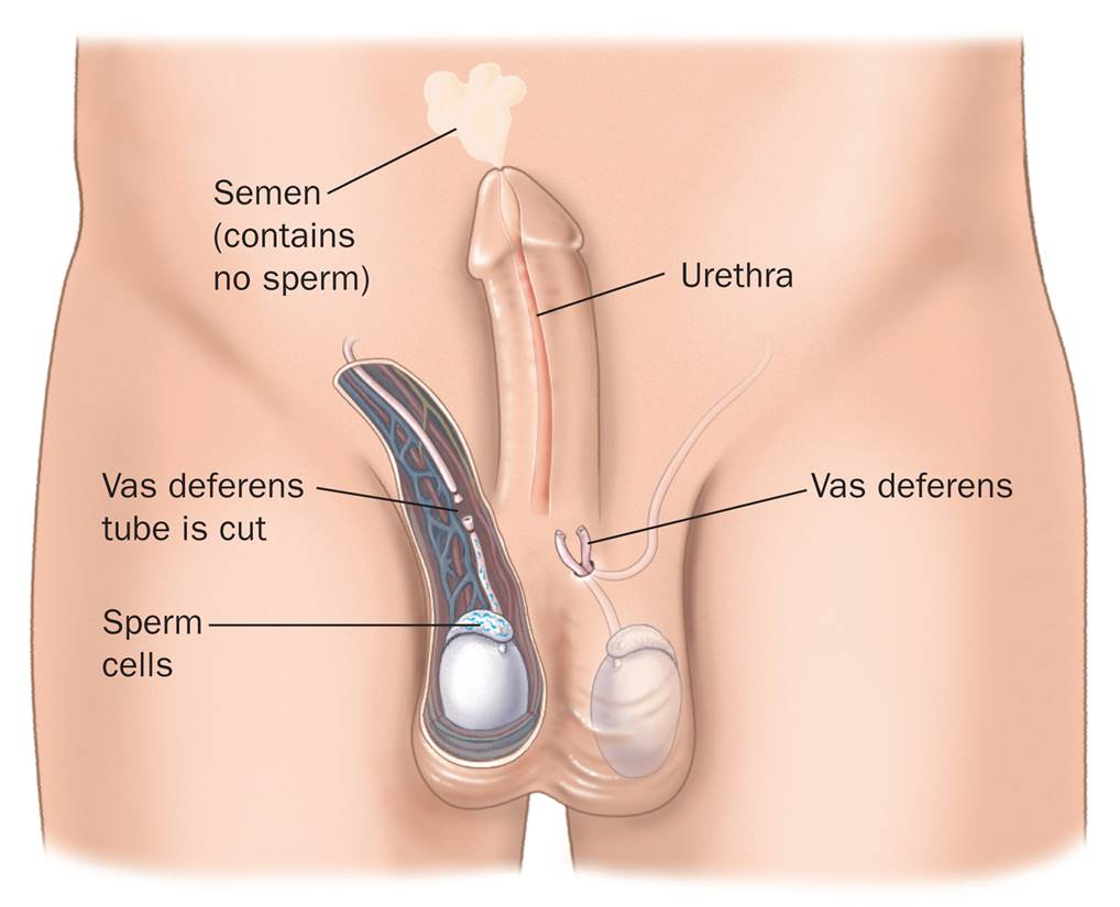 Vasectomy Procedure 