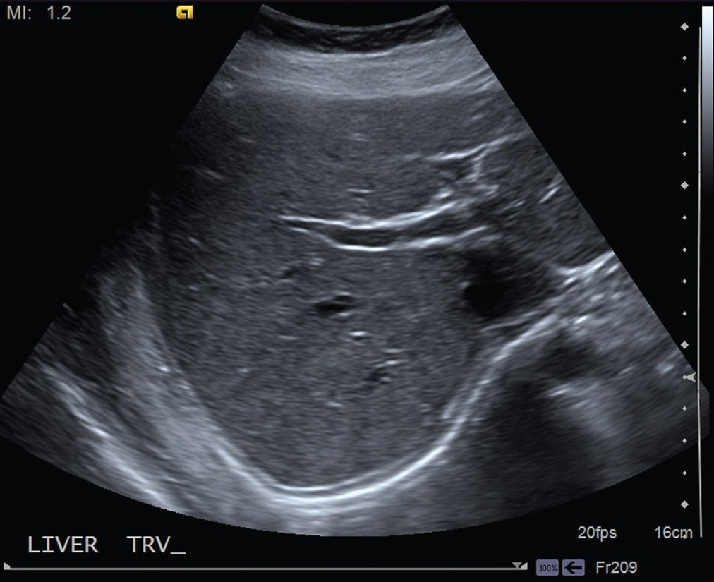 An ultrasound echogram or sonogram of the abdomen. 