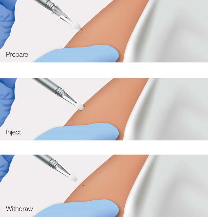 One type of safety needle withdraws into a protective sheath when the injection is complete.