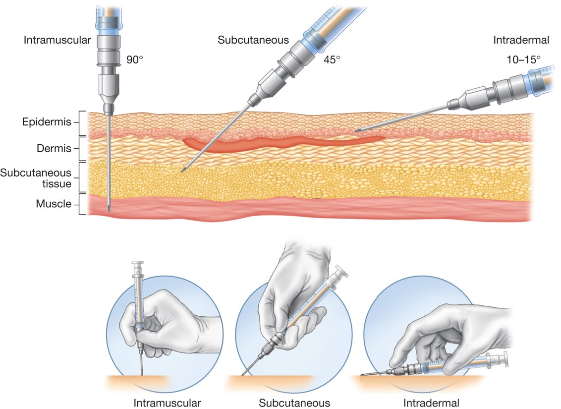 Angle of insertion for three types of injections.