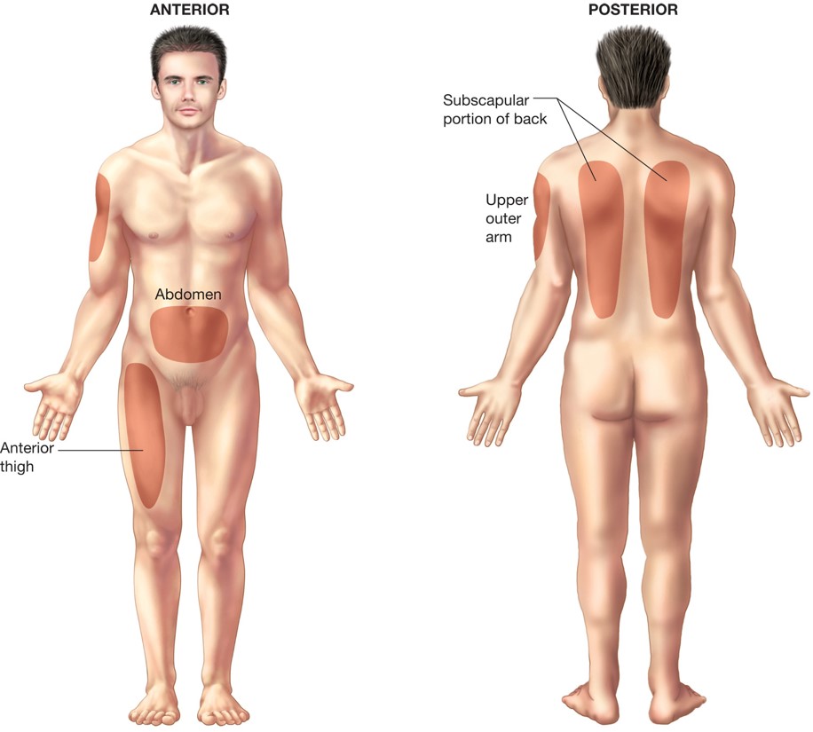 Sites for subcutaneous injection.