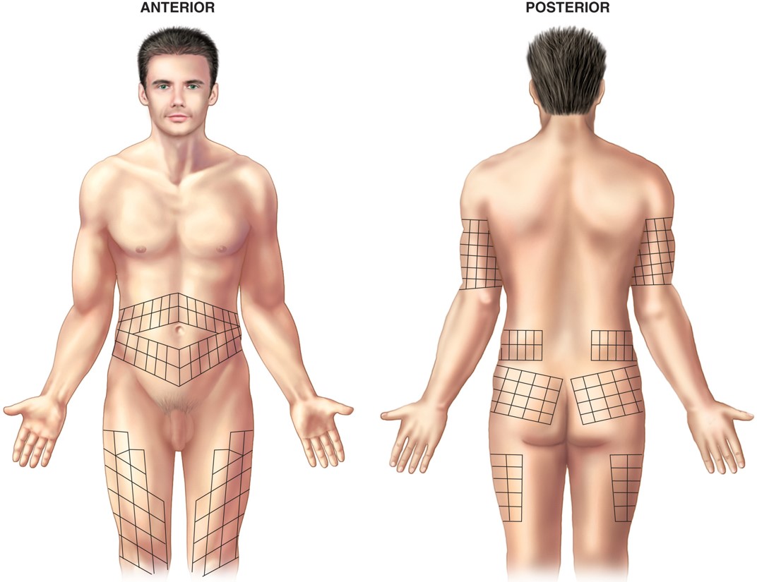 Rotation sites for administering insulin.